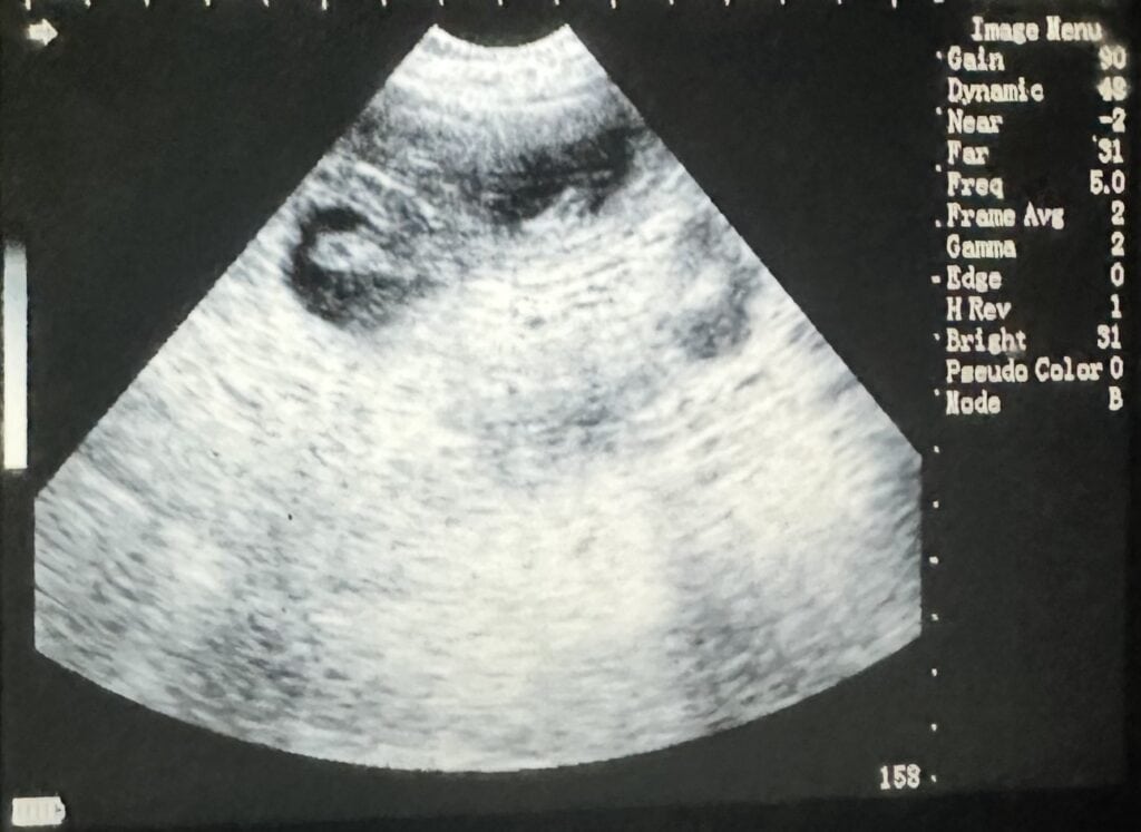 A picture of an ultrasound on a computer screen.